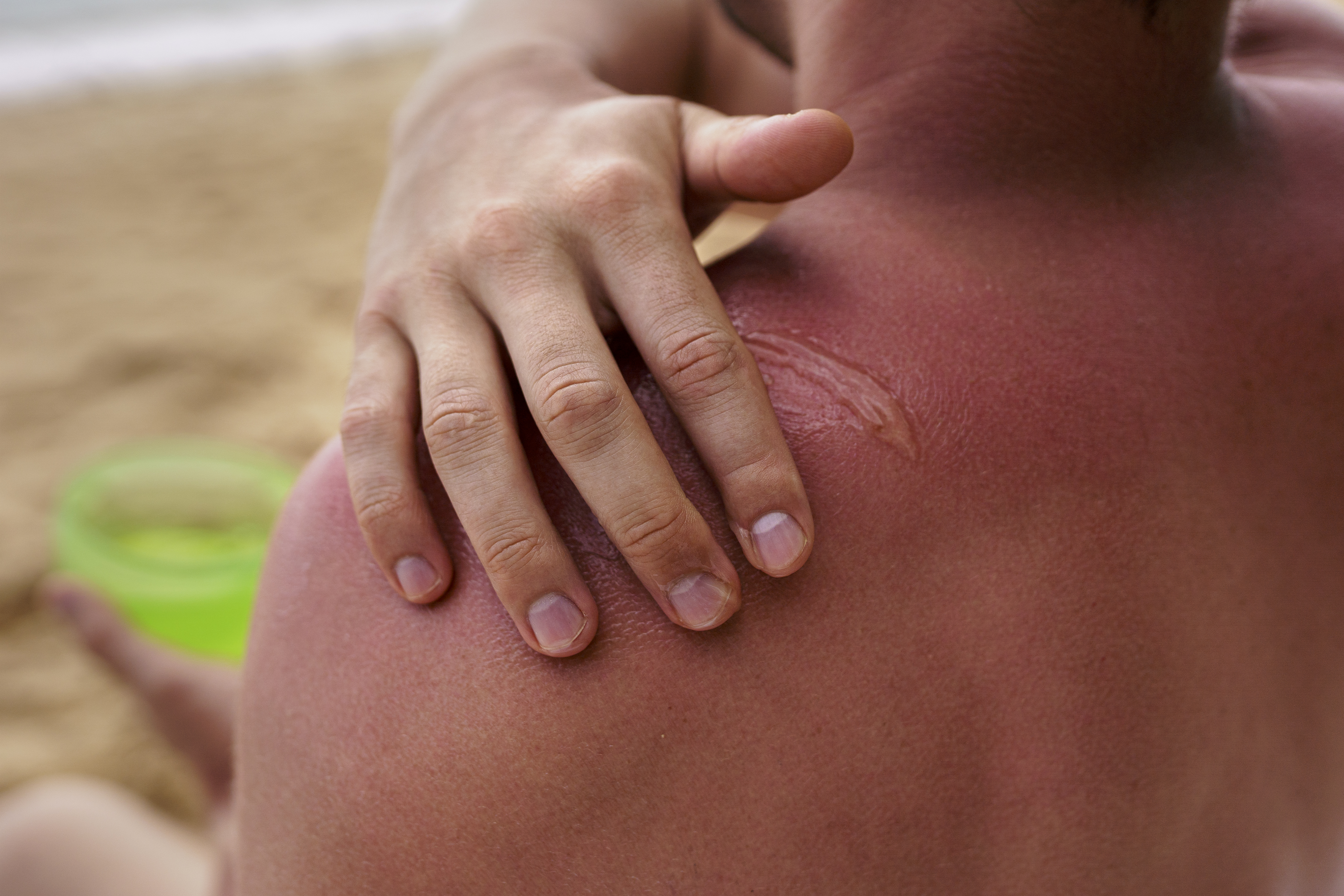 BURN SCAR TREATMENT & RECONSTRUCTION